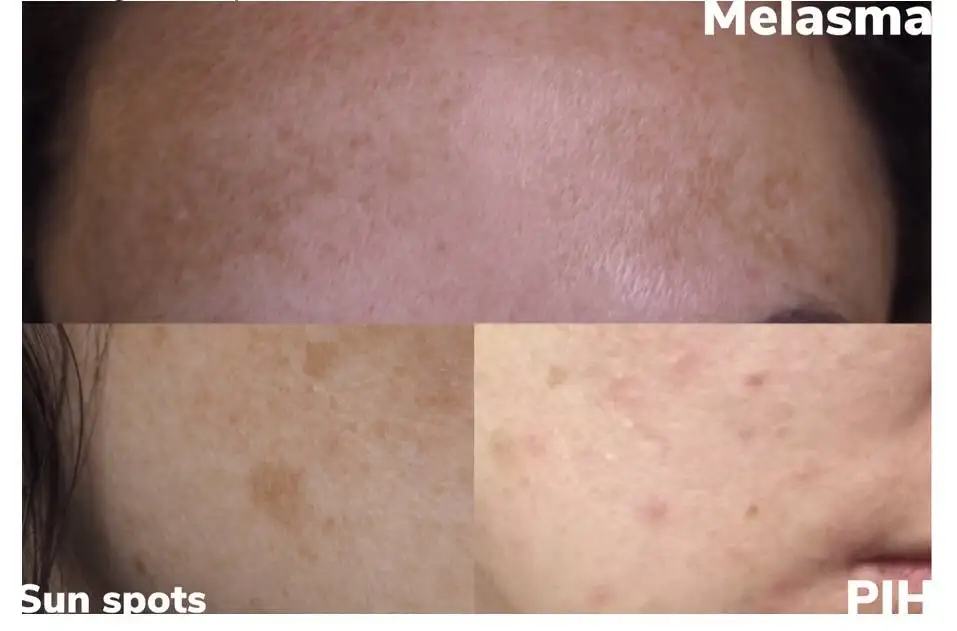 The Ordinary Pigmentation & Melasma