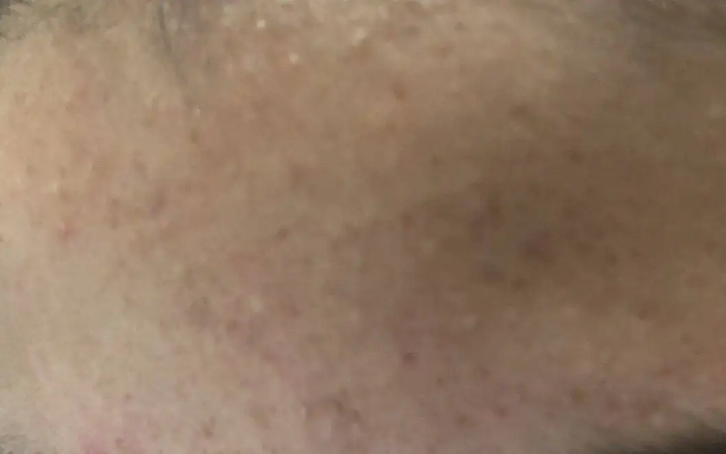 Photo of closed comedones on forehead.