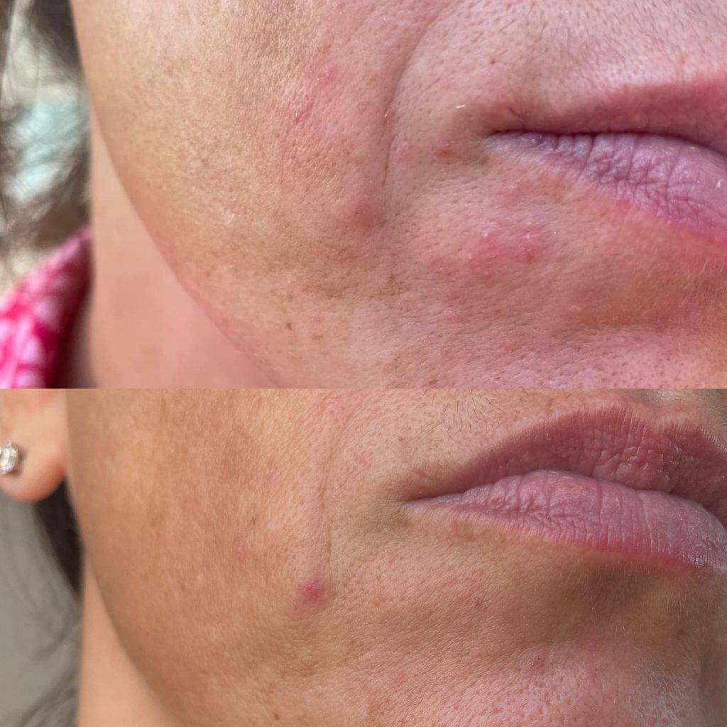 The Ordinary & Perioral Dermatitis