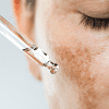 Melasma