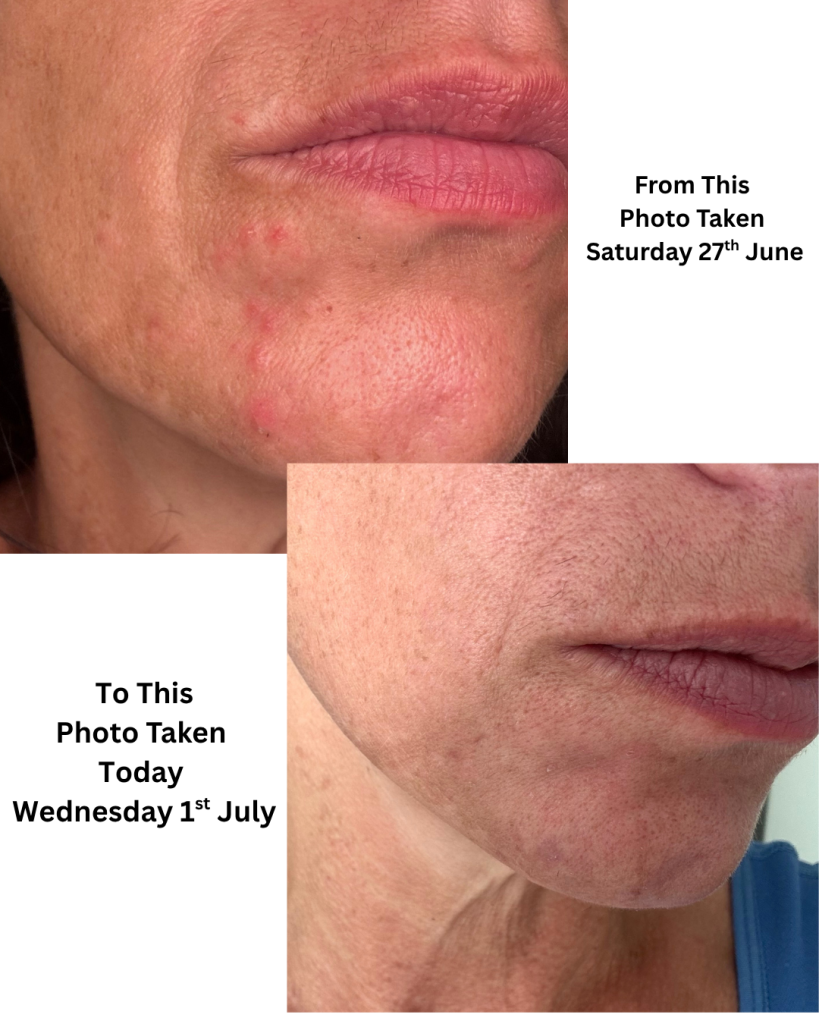 Before & After Perioral Dermatitis in 5 days 